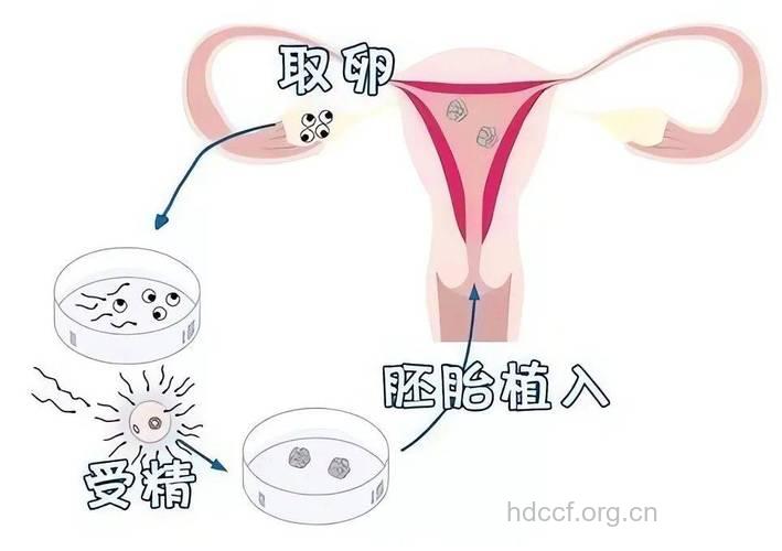 试管婴儿的手术原理