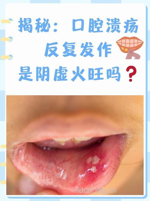 口腔溃疡不是“火气大”