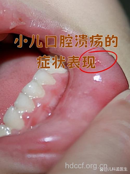 口腔溃疡为何总是“偏爱”宝宝