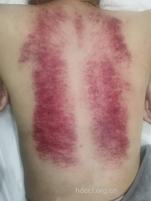 刮后背可以治疗口腔溃疡？