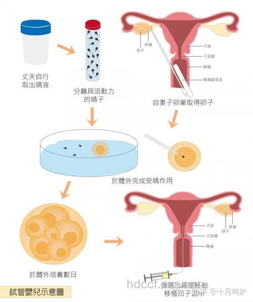 细数试管婴儿过程有哪些