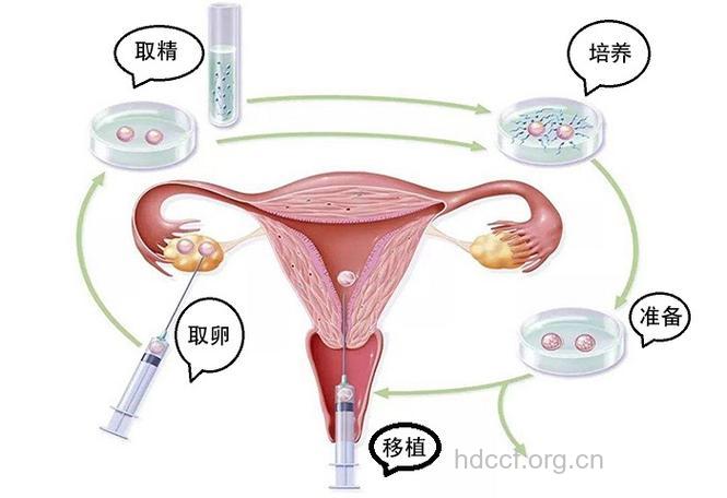 “借卵生子”——试管婴儿新方法
