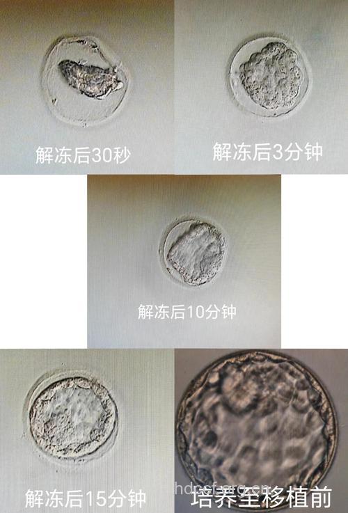 胚胎冷冻技术是怎么回事?