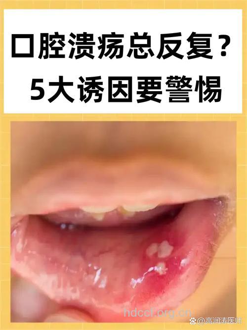 口腔溃疡 不宜