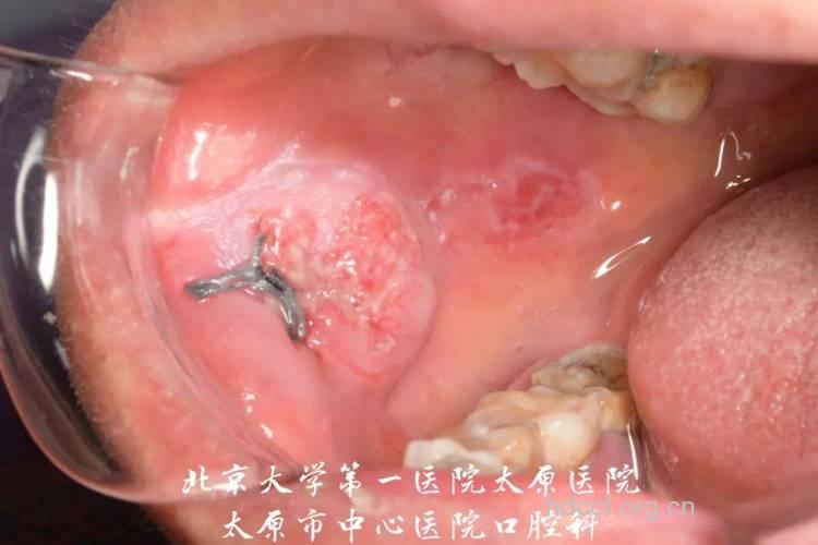 口腔溃疡可能癌变