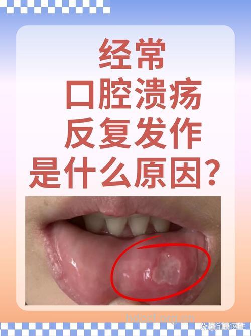 研究发现口腔溃疡源于病毒感染