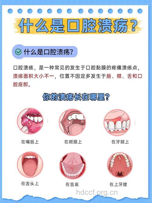 同是口腔溃疡 治法为什么不一样?