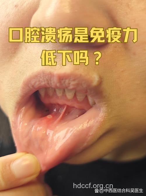 免疫力低下可致口腔溃疡