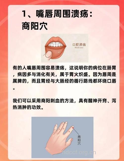 口腔溃疡的疗法