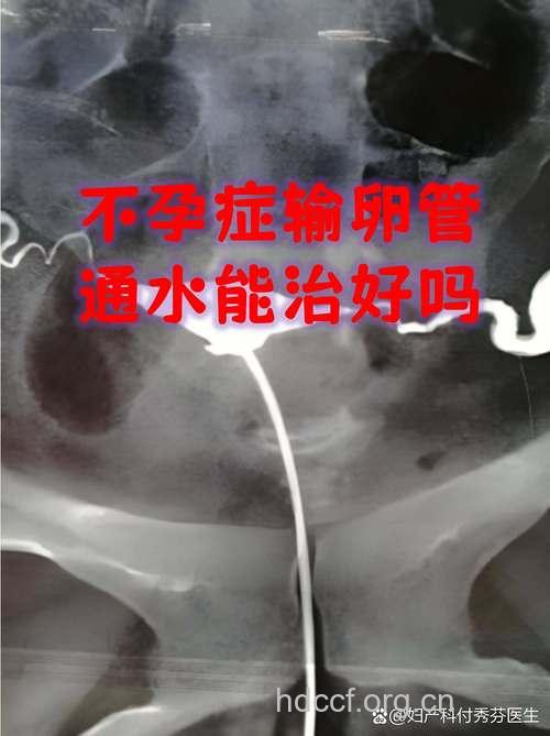 不孕治疗:输卵管畸形能治好吗