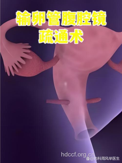哪些手术方法可治疗输卵管堵塞