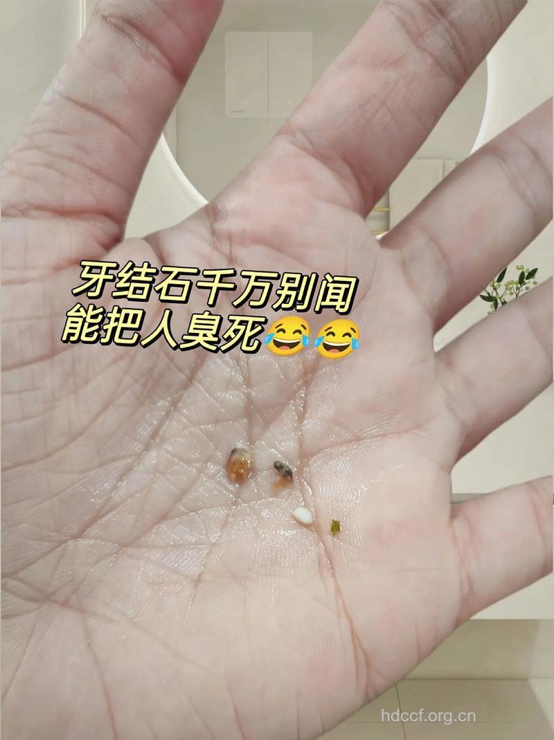 口臭可能是牙结石在作怪