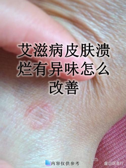 艾滋病毒天然屏障有望打开