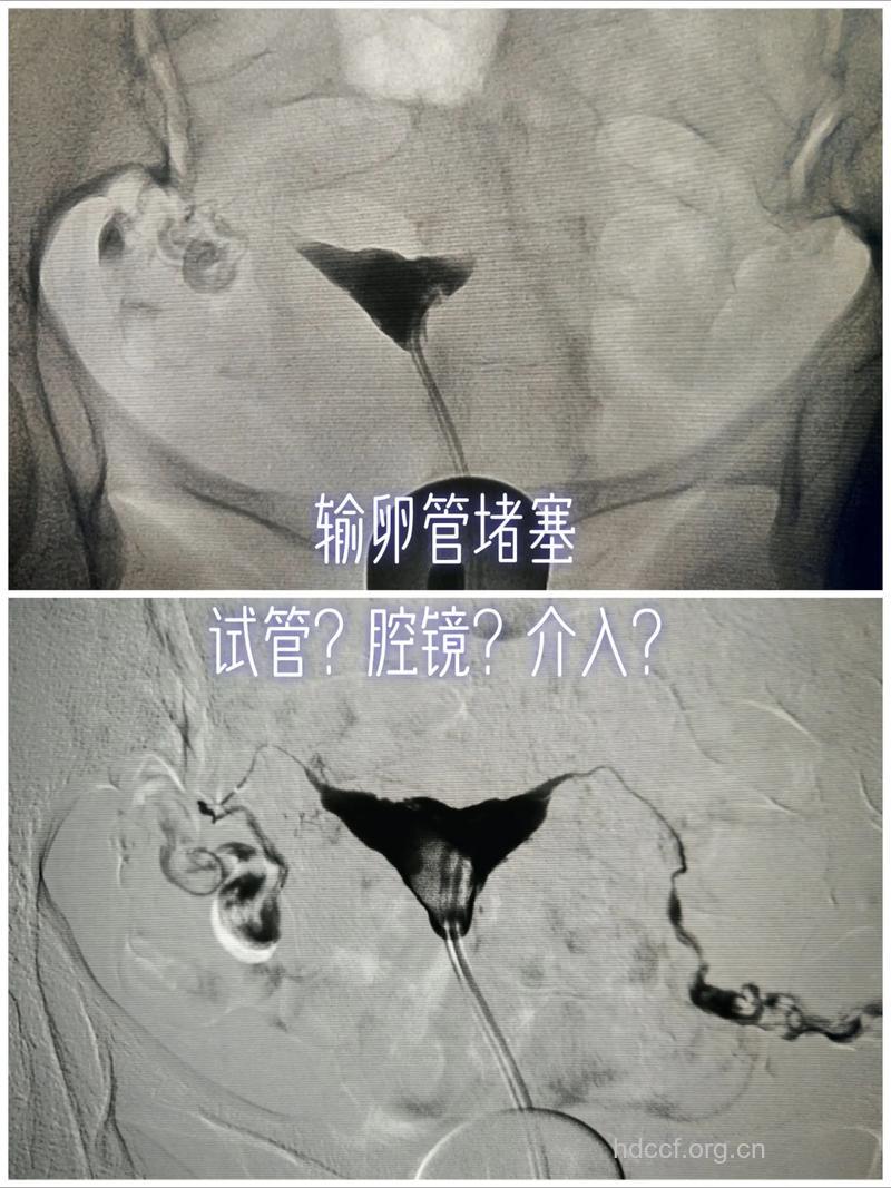 输卵管性不孕的介入治疗