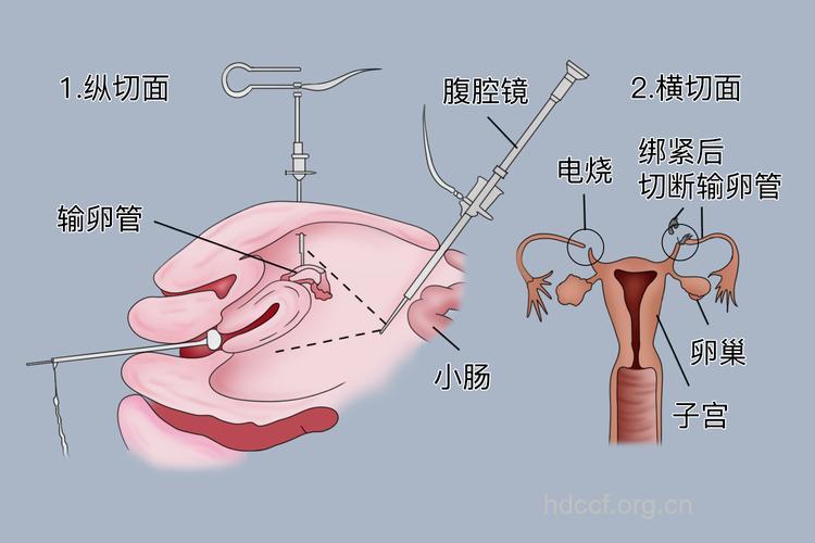 输卵管性不孕的手术方式有哪些?
