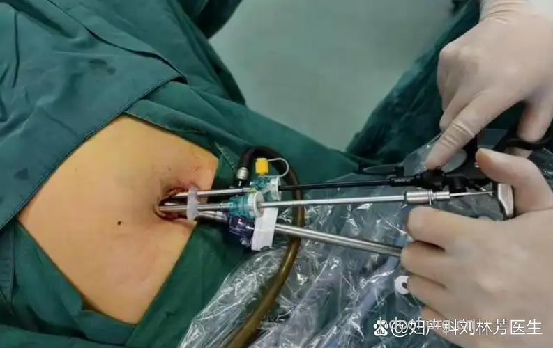 输卵管阻塞的手术方式