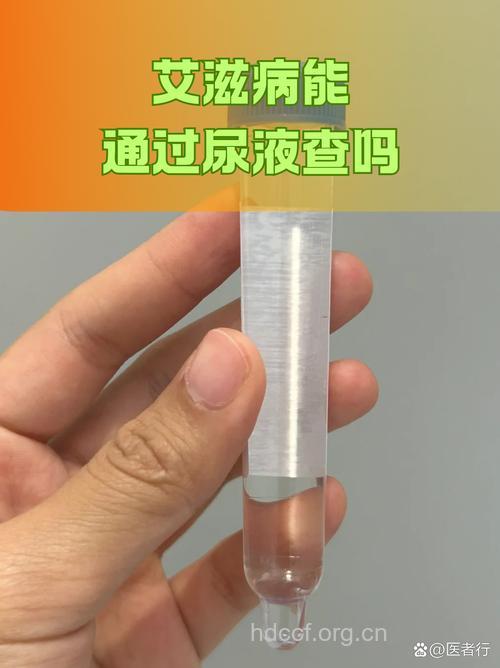 尿液也可检查艾滋病