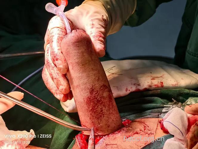 男性不育手术治疗