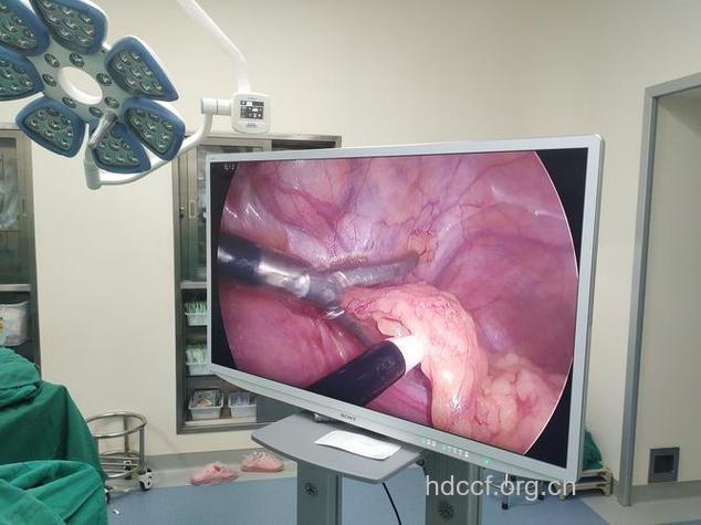 输卵管通液术是什么样的?