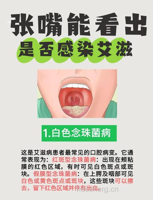 口腔病变须警惕艾滋