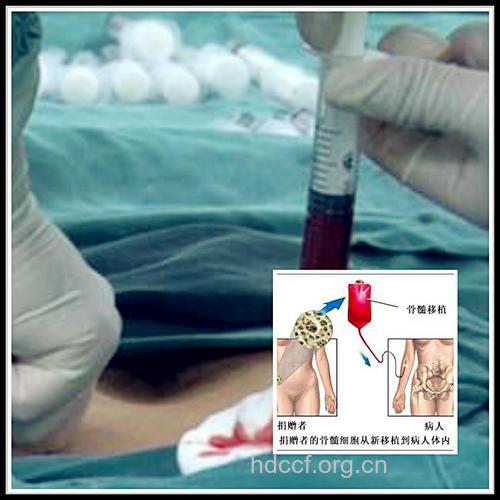 美媒宣告骨髓移植治艾滋病希望破灭