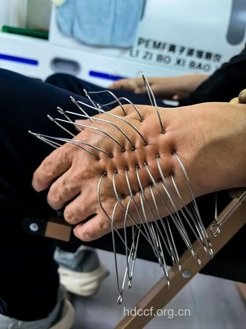 治疗不育症的针灸方法