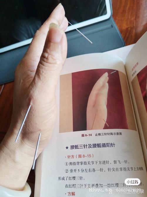 男性不育的针灸治疗法