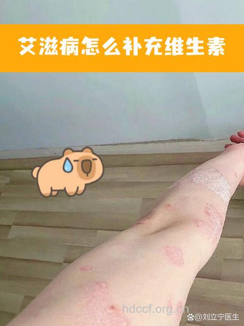 艾滋病感染者要补充哪些维生素