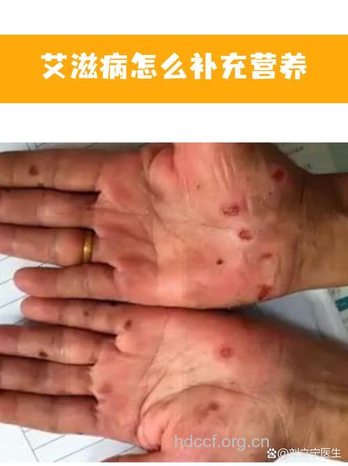 艾滋病住院治疗意义不大
