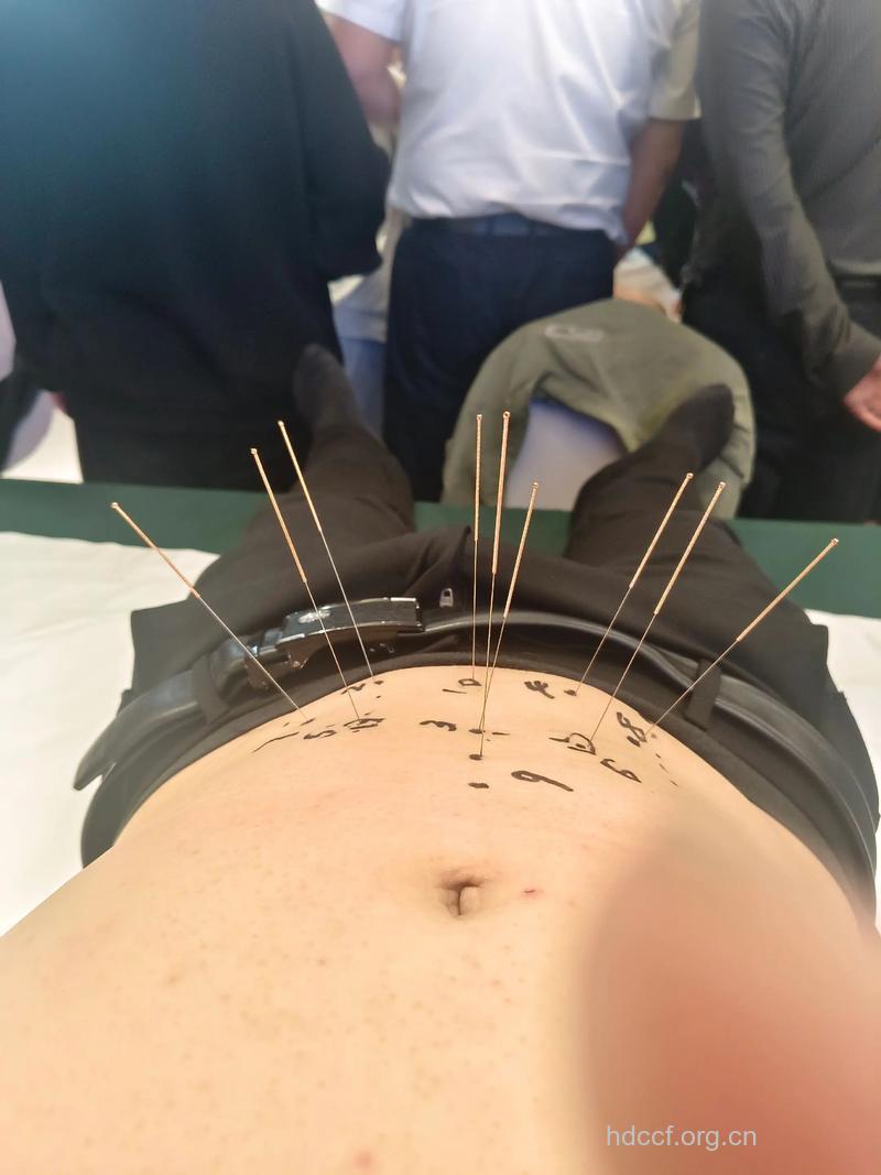男性不育 针灸治疗有奇效