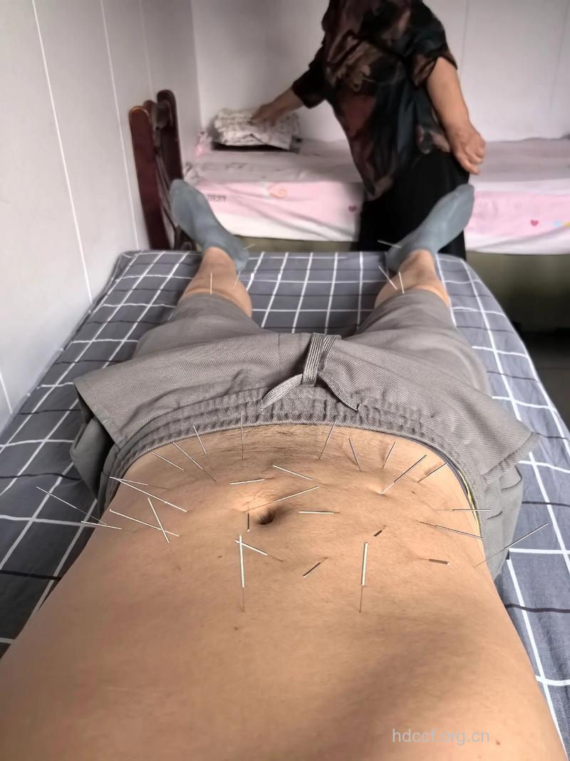 针灸可治疗男性不育症
