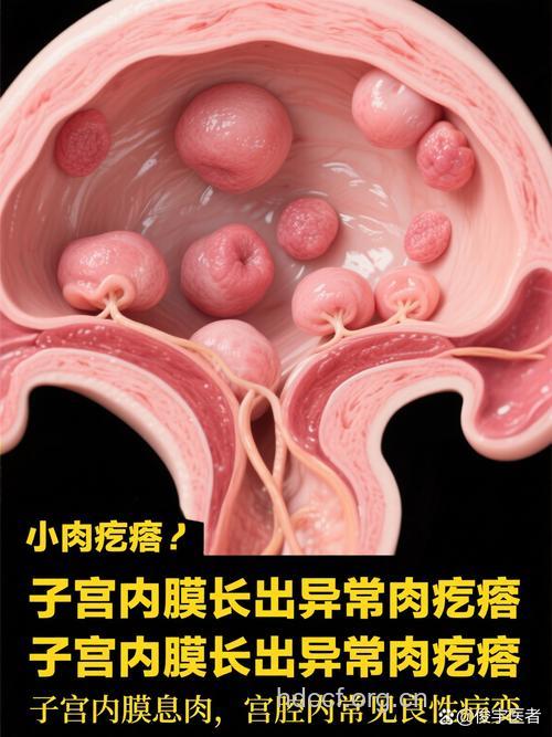 小小息肉 阻碍怀孕