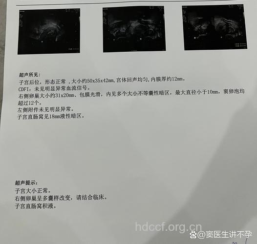 不孕病例 多囊卵巢综合症
