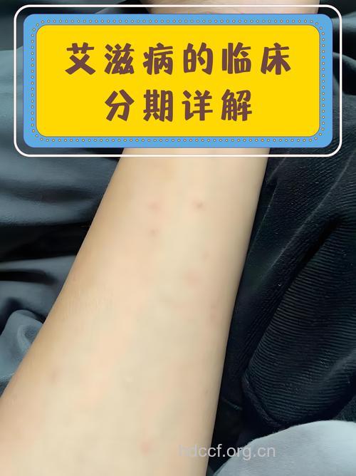 艾滋病病毒抗药性上升