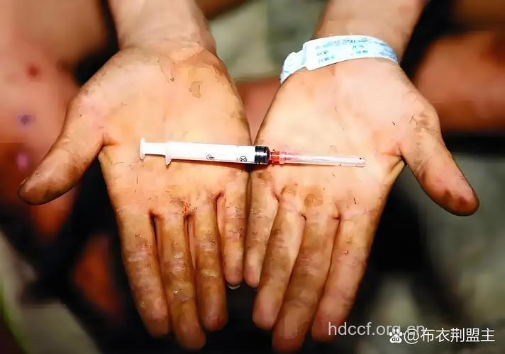 艾滋病疫苗I期人体试验获成功