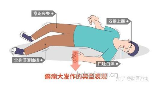 癫痫发作的过程是怎么样的