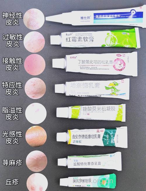 神经性皮炎有什么危害 巧用中药治疗