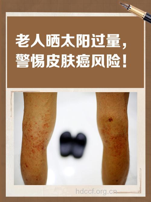 经常晒太阳会患皮肤癌吗