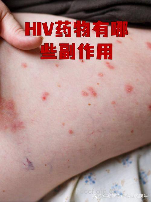 HIV抗病毒药物副作用是因人而异的