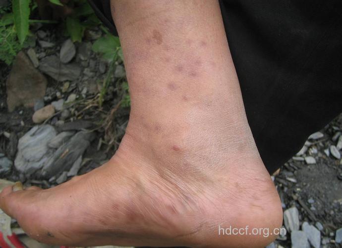 麻风病早期有哪些常见症状