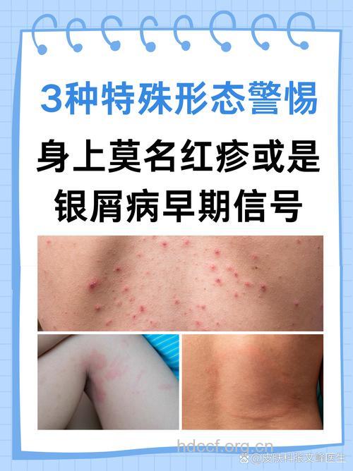 夏季需要警惕这4种皮肤病