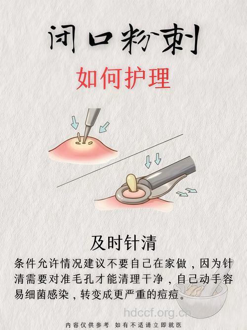 如何拔粉刺以及护理方法