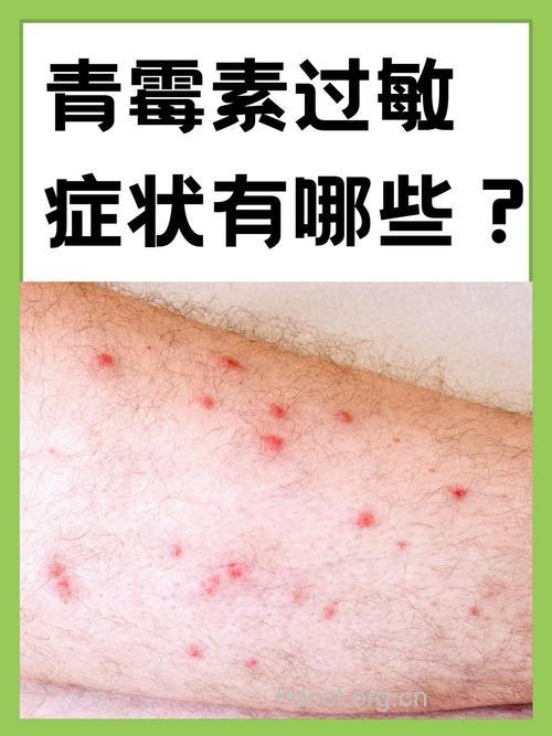 青霉素导致的皮肤过敏怎么办