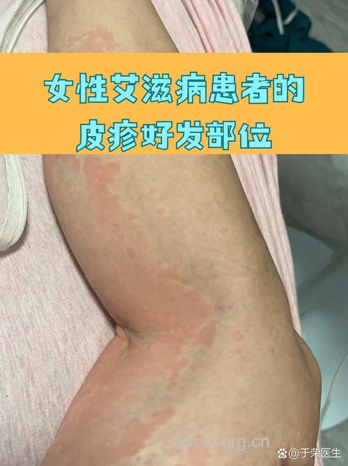 女性感染了艾滋病后有哪些症状