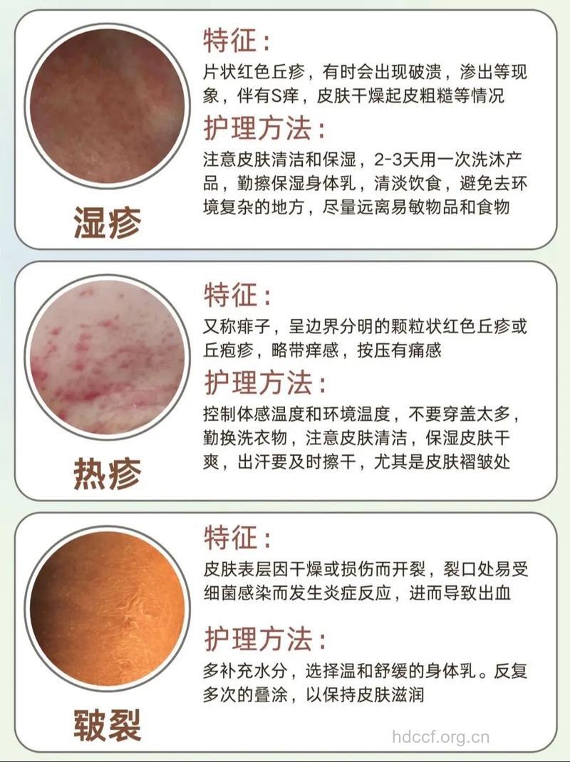 秋季七种常见的皮肤病如何防治
