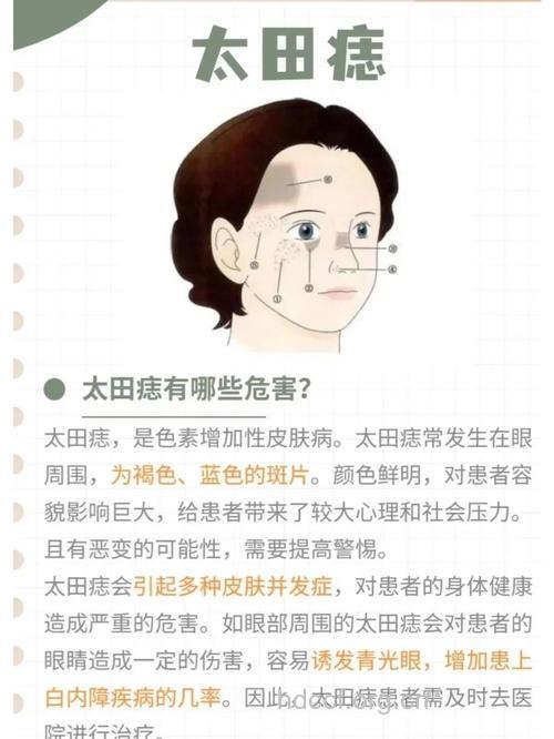 太田痣的病因是什么呢