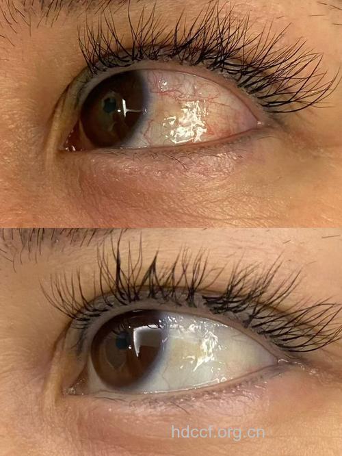 眼睛颜色也能看出皮肤病