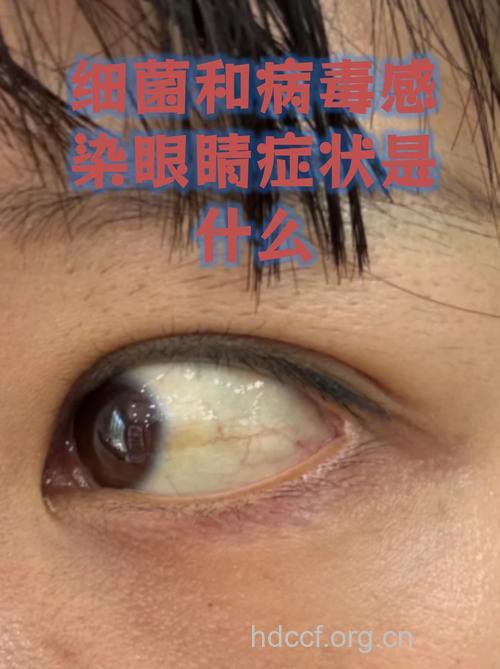 艾滋病竟会引发眼病？