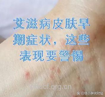 艾滋病毒感染的体液免疫特征