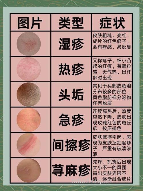 春季要当心三类皮肤病